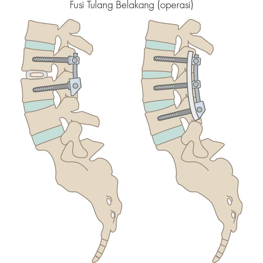 Pengobatan alternatif fusi tulang belakang