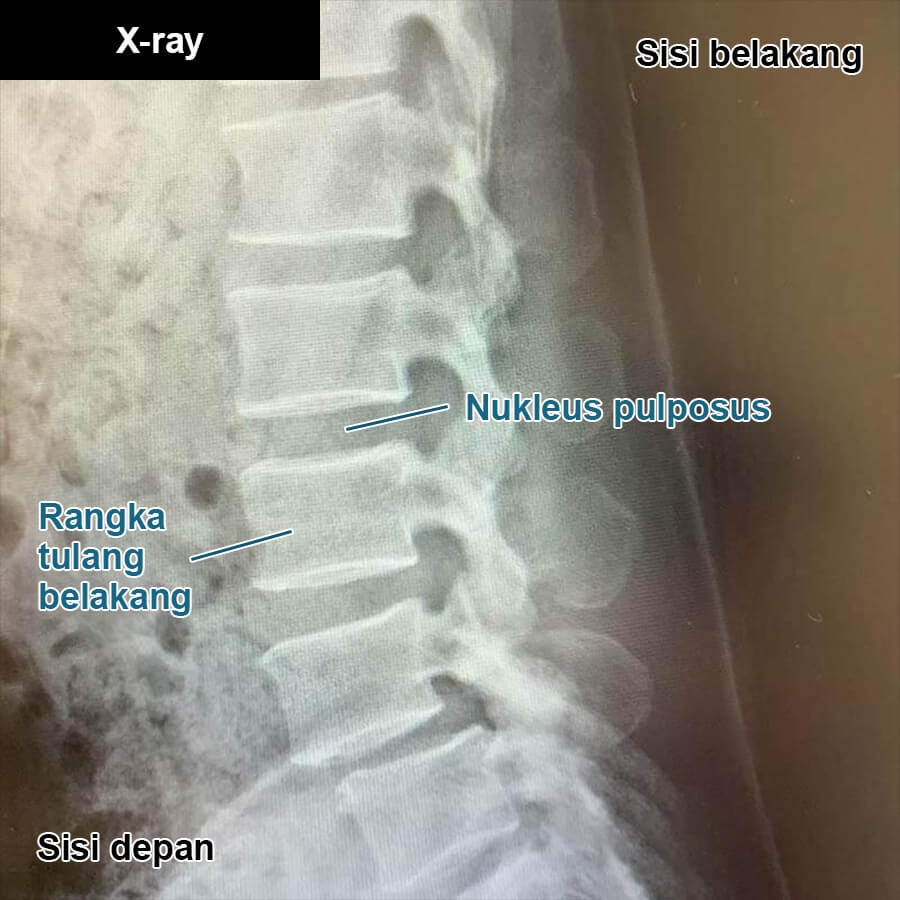 Bagaimana spondilolisthesis didiagnosis?：pemeriksaan x-ray