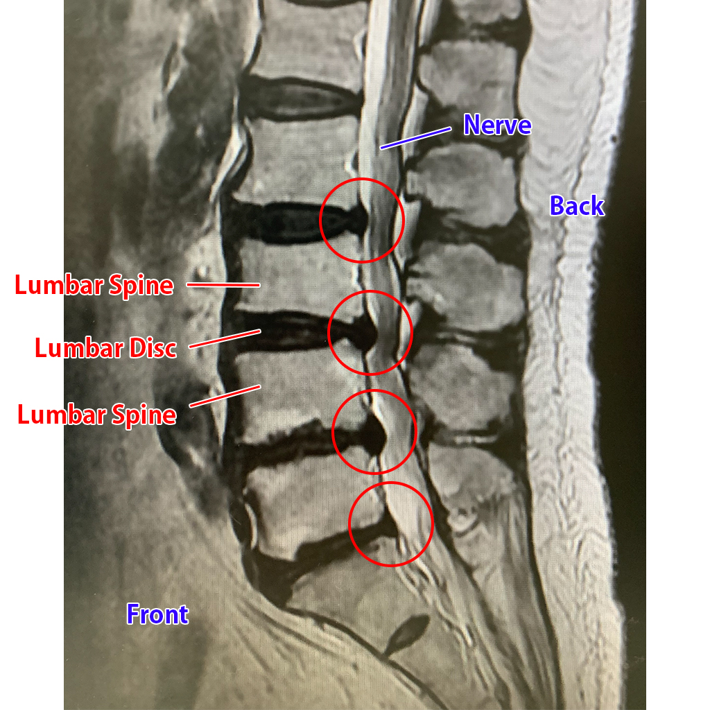 Gambar MRI Pinggang