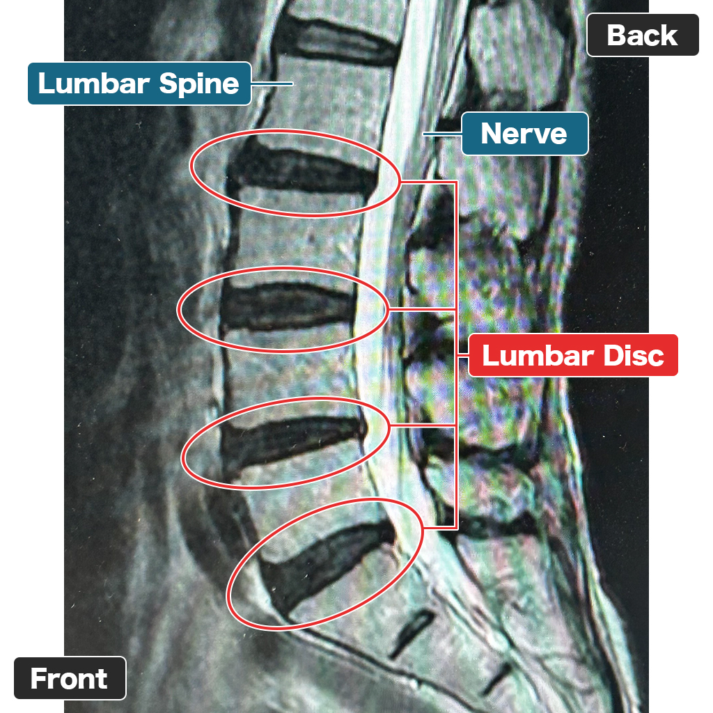 MRI