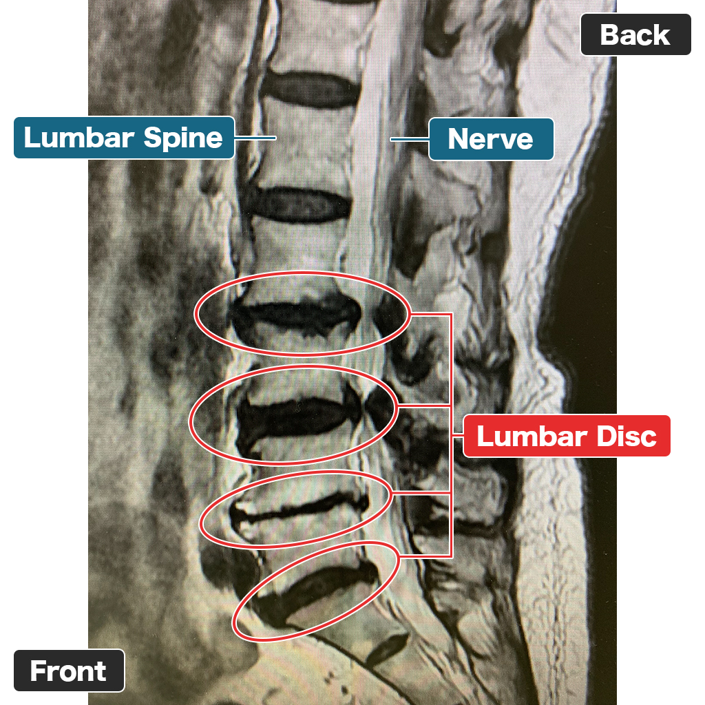 MRI