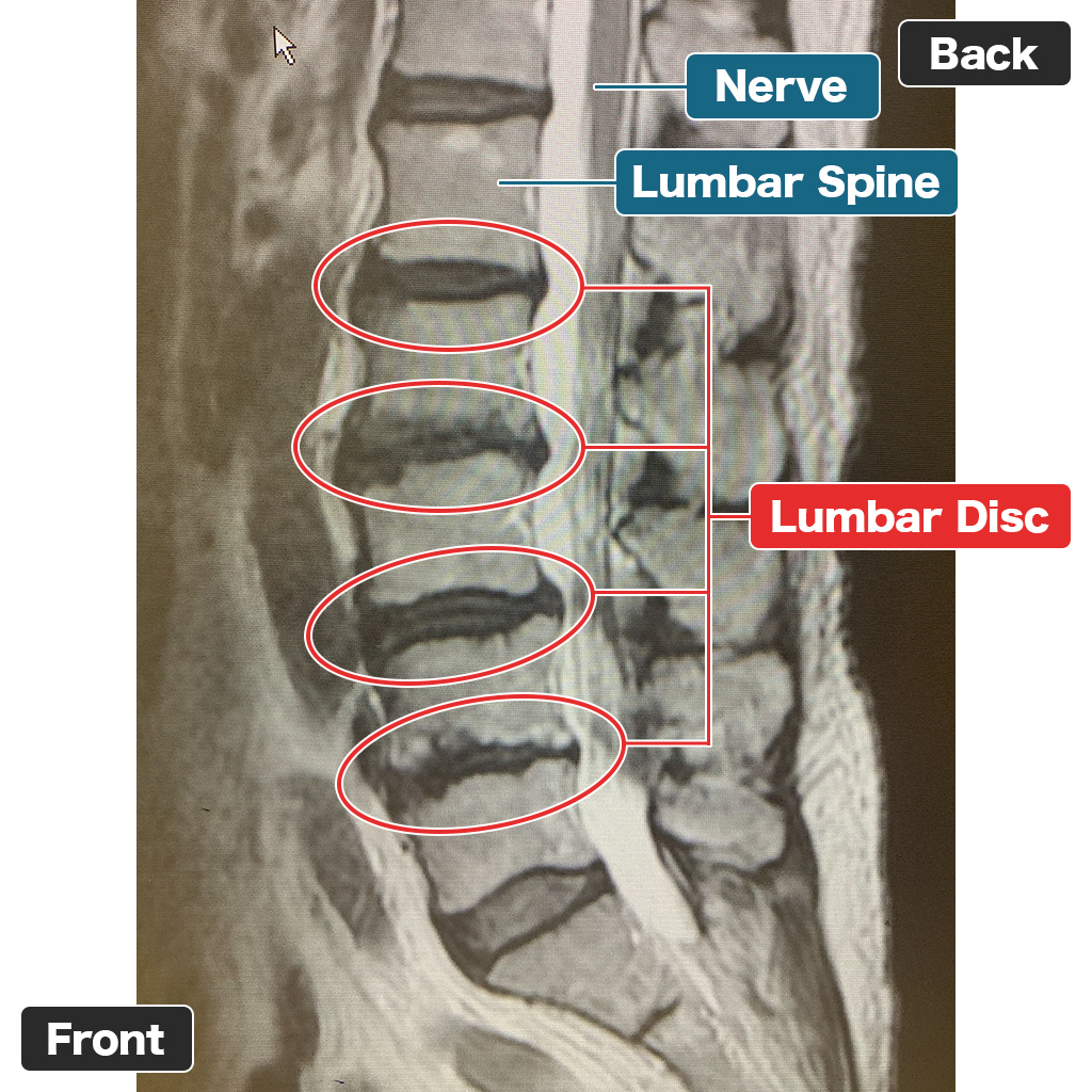 MRI