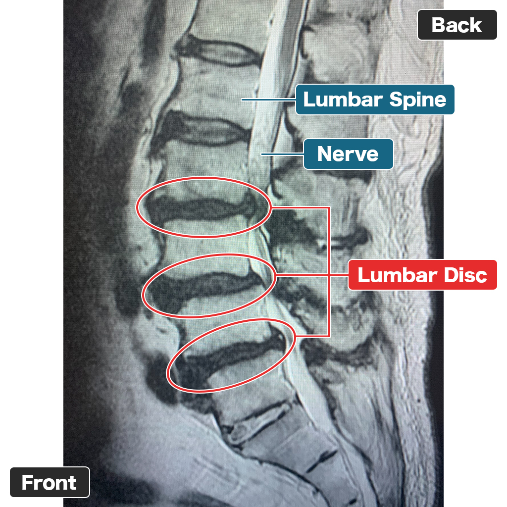 MRI