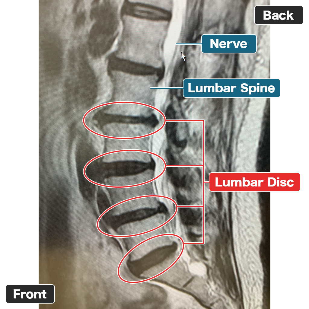 MRI