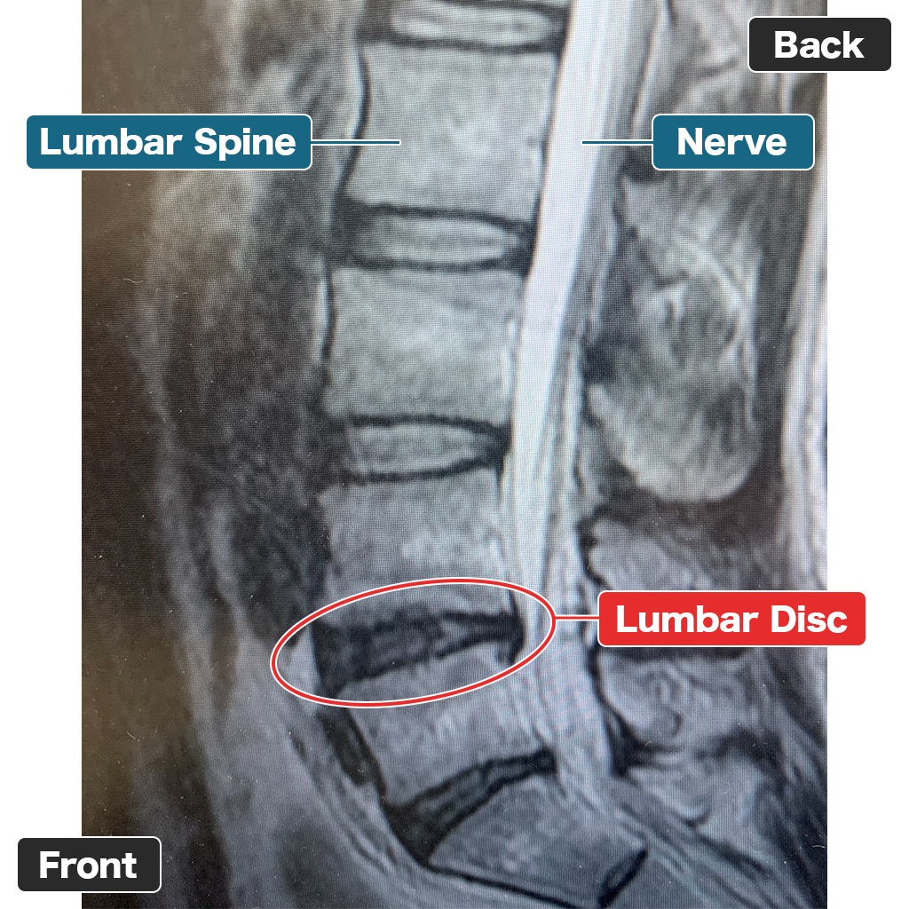 MRI Sebelum Terapi