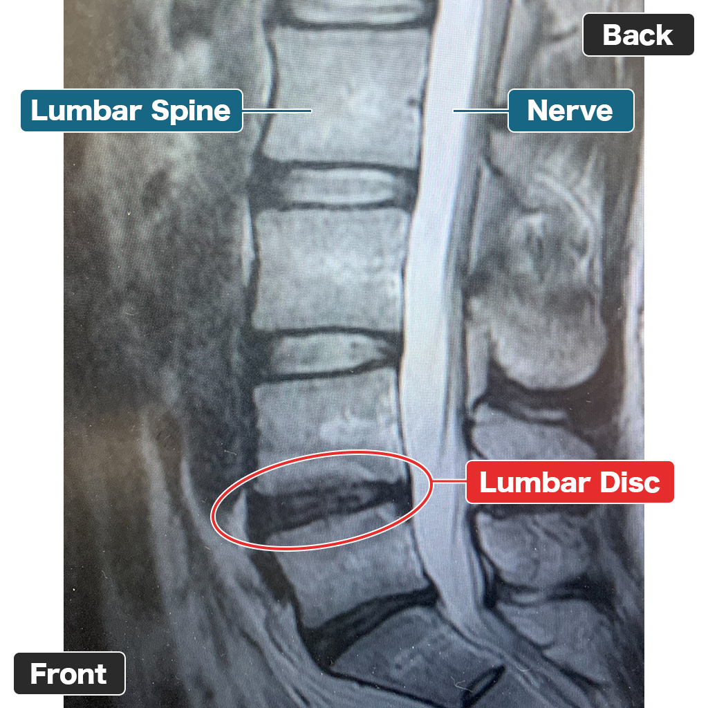 MRI Setelah Terapi