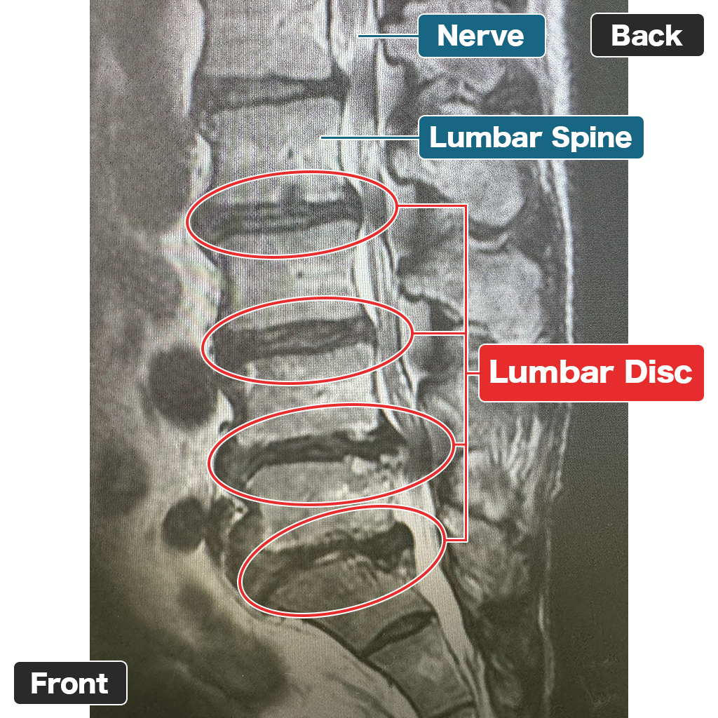 MRI