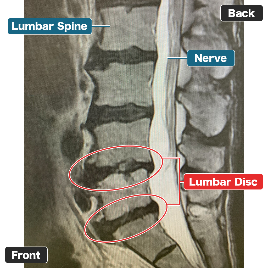 Gambar MRI pinggang