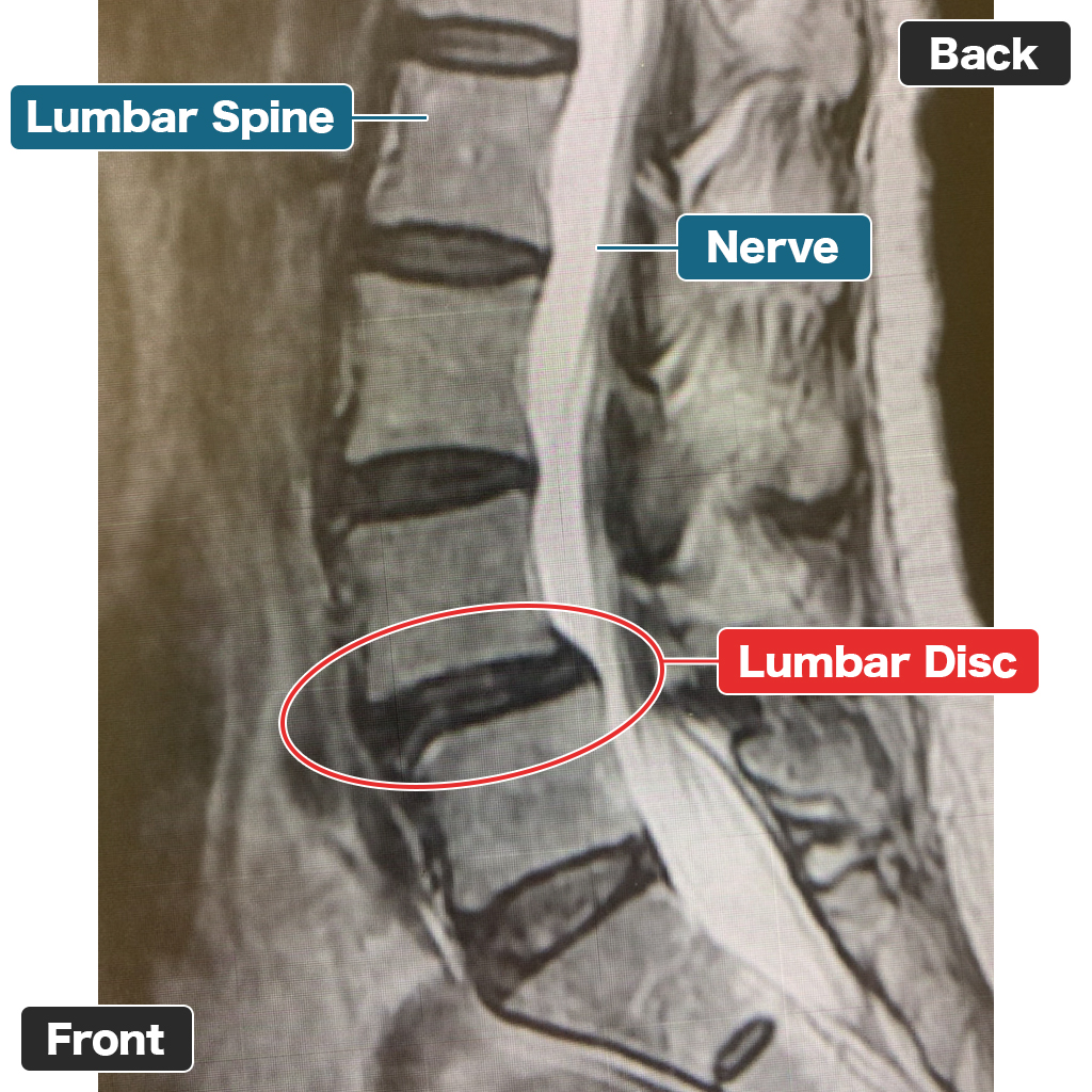 MRI Setelah Pengobatan