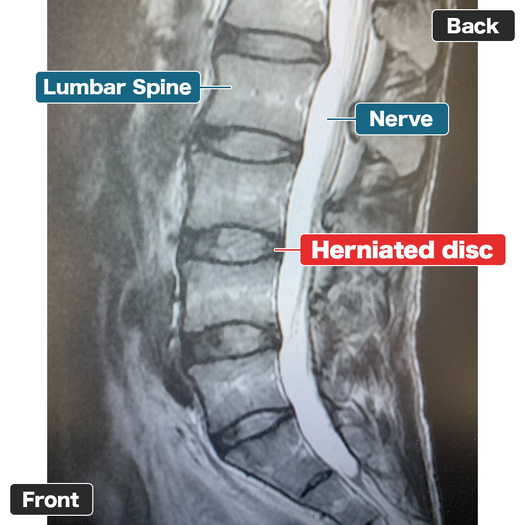 MRI