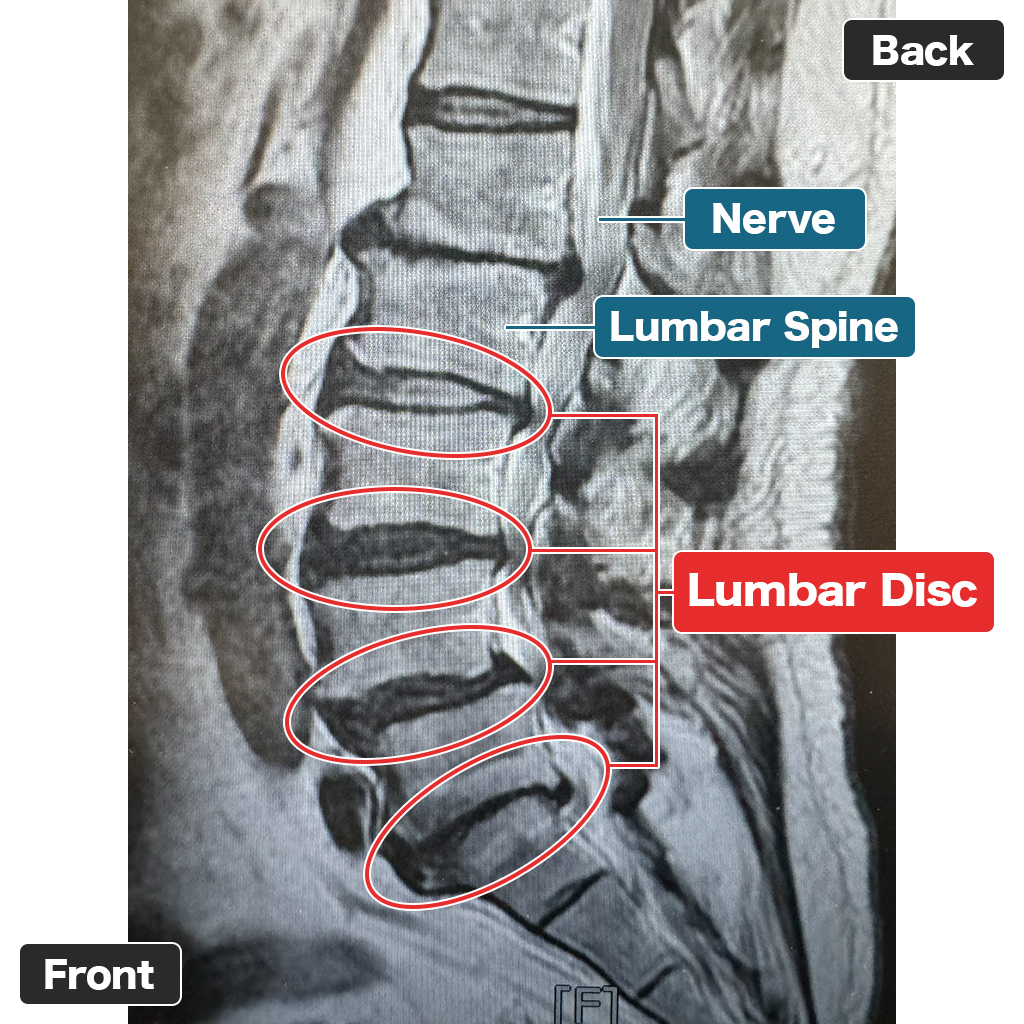 MRI