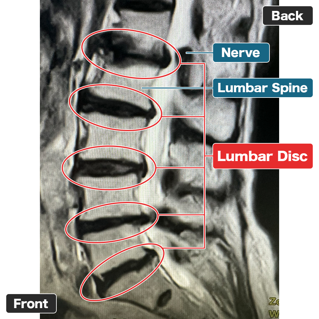 MRI