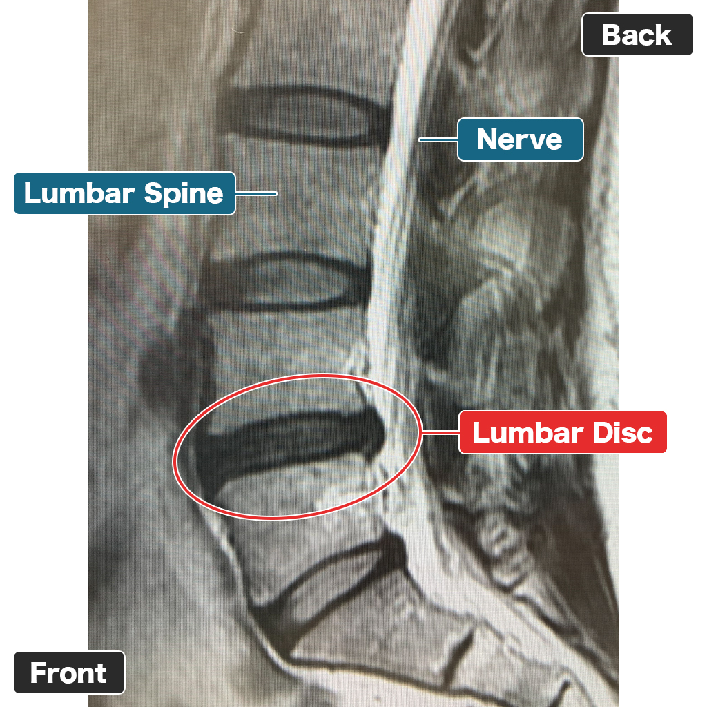 Seorang Pasien 1 tahun 2 bulan setelah Perawatan Laser untuk Herniasi Diskus