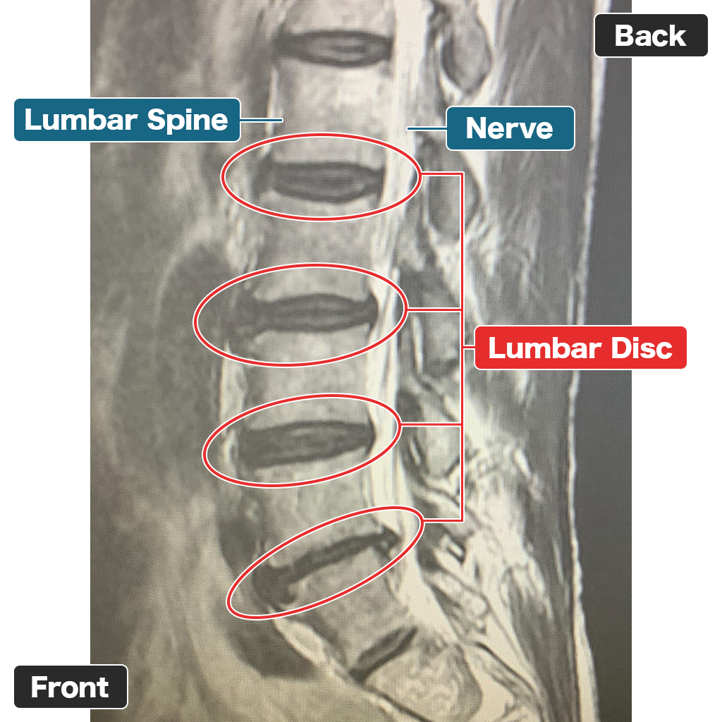 MRI