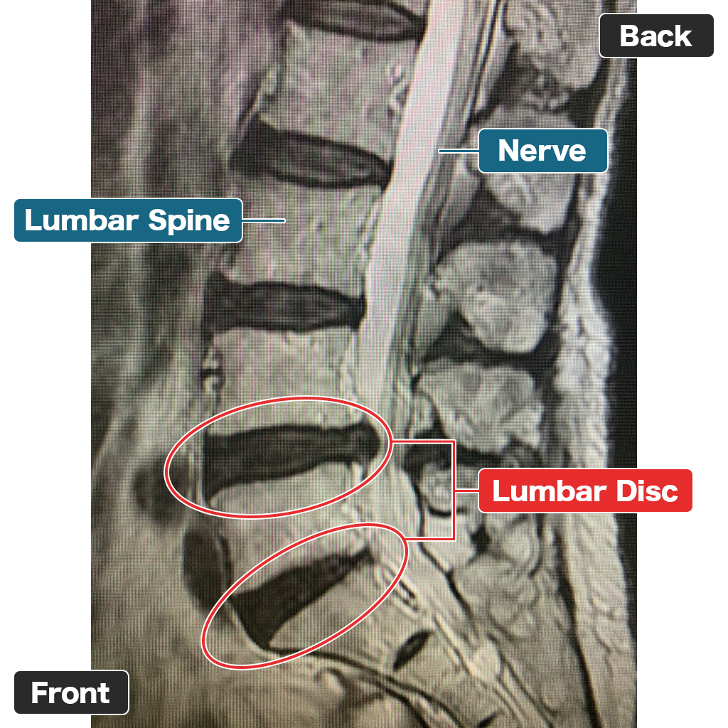 MRI Sebelum Pengobatan