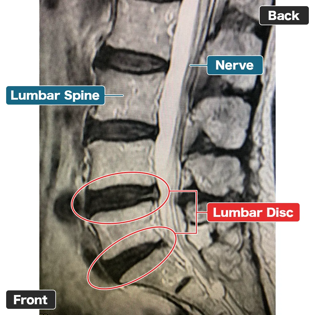 MRI Setelah Pengobatan