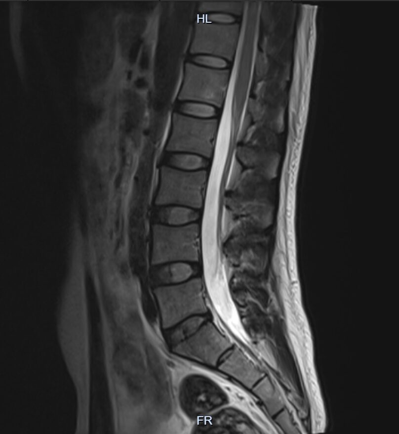 MRI