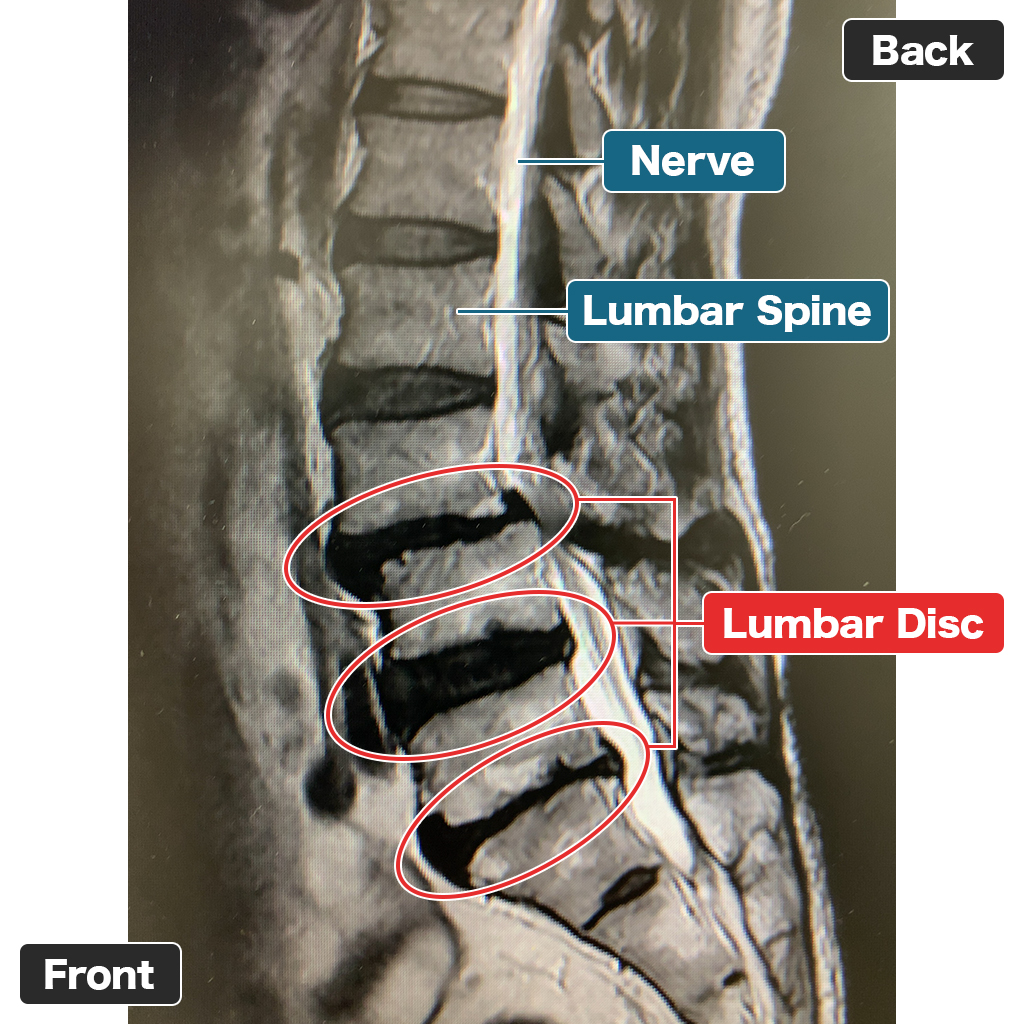 MRI