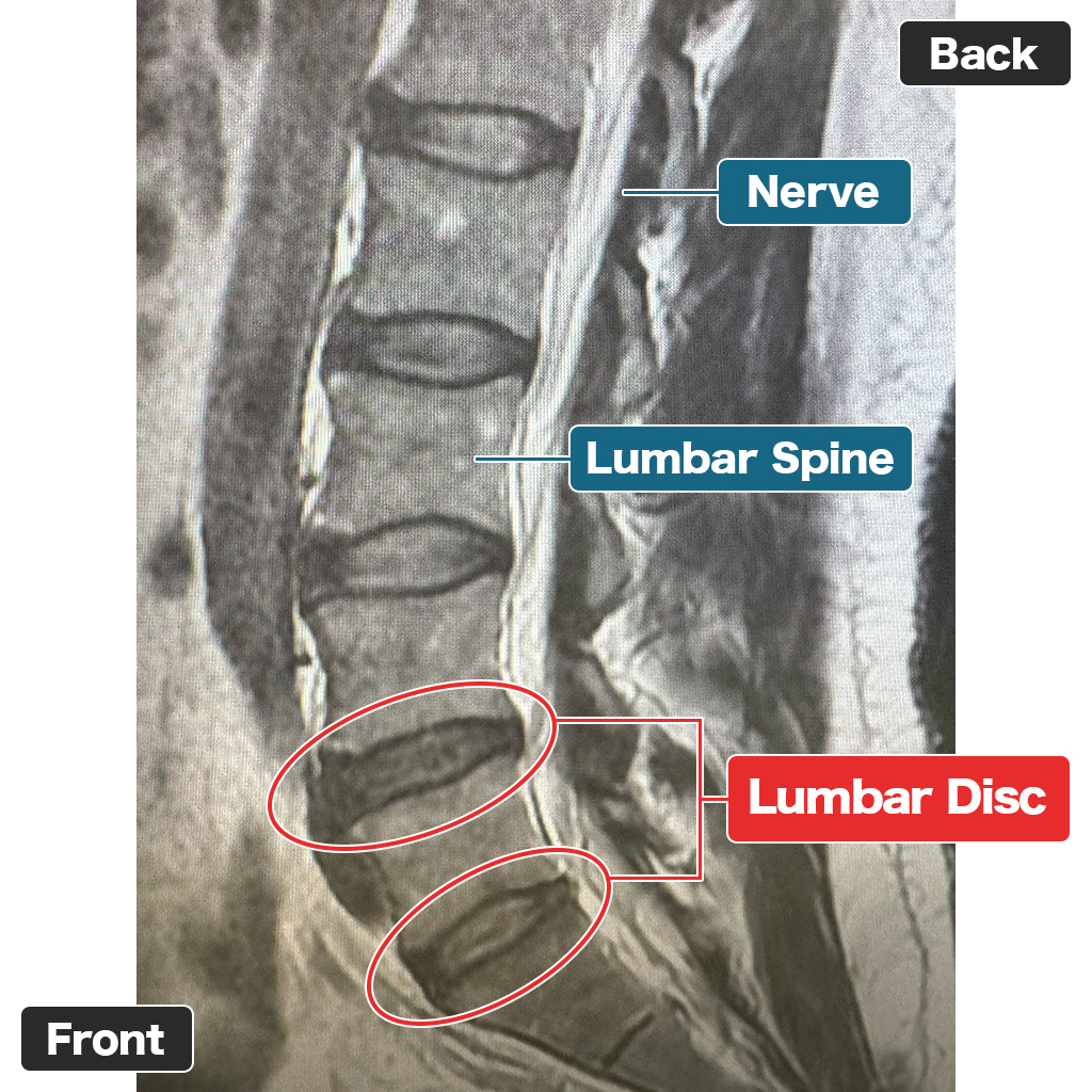 MRI