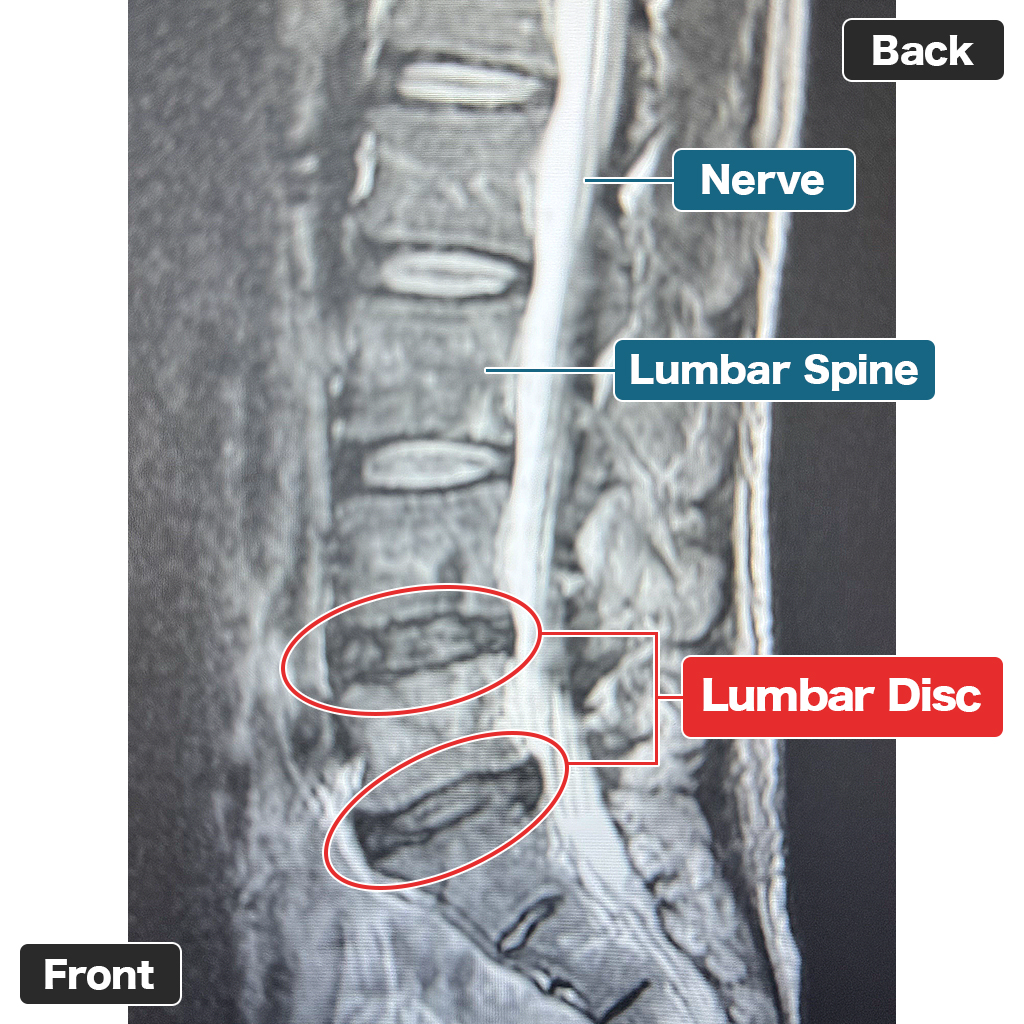 MRI
