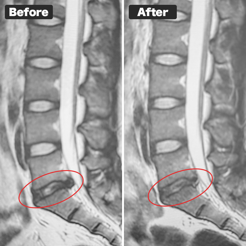 Gambar MRI Sebelum dan Sesudah Perawatan