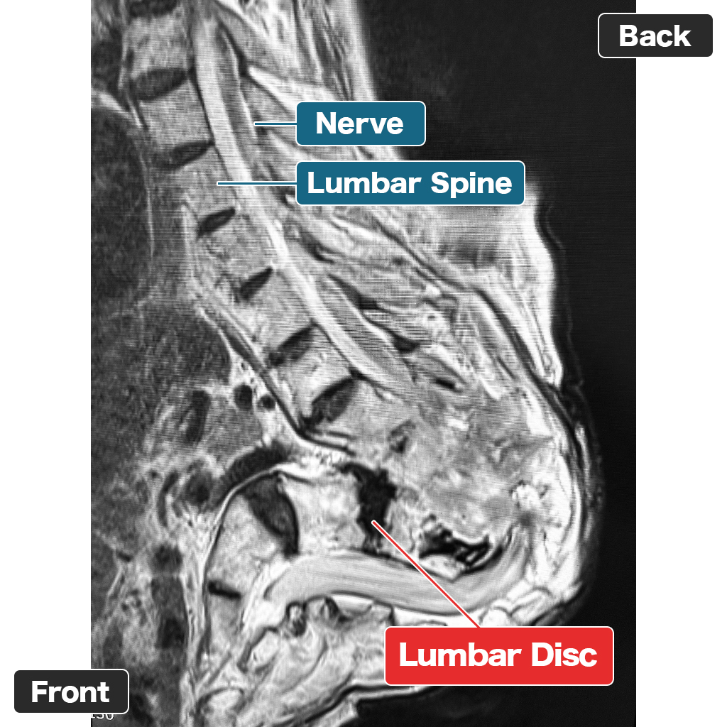 MRI