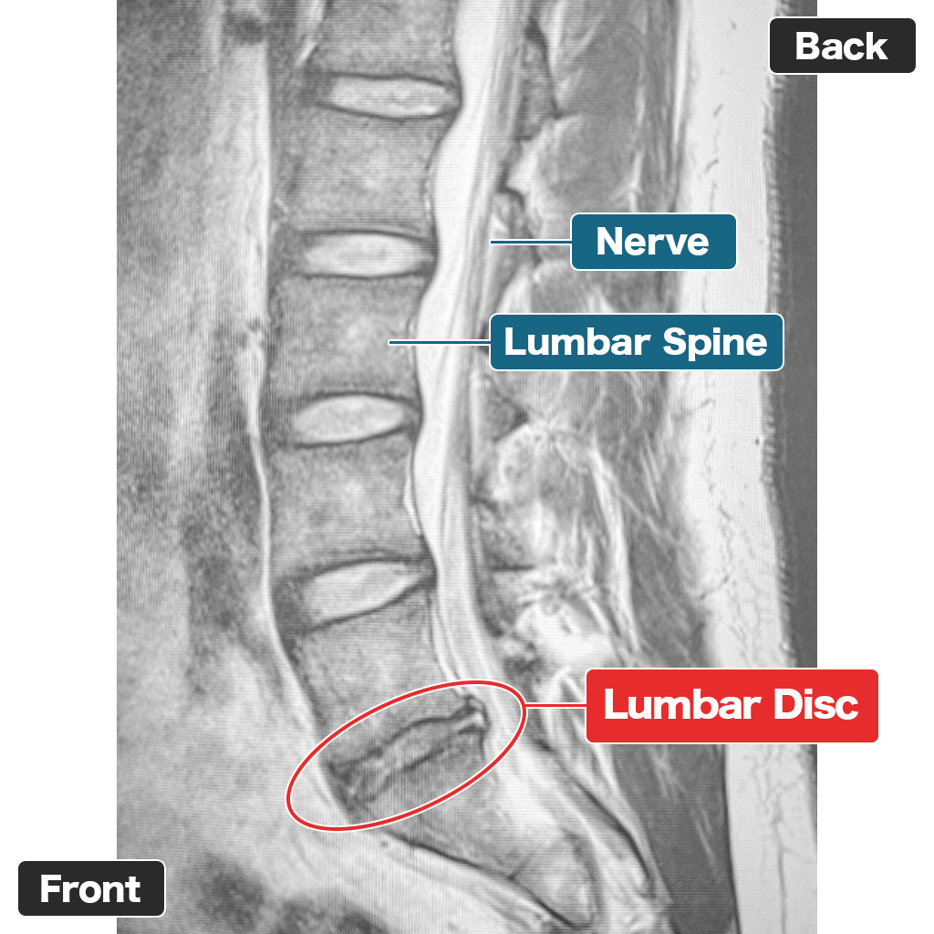 MRI
