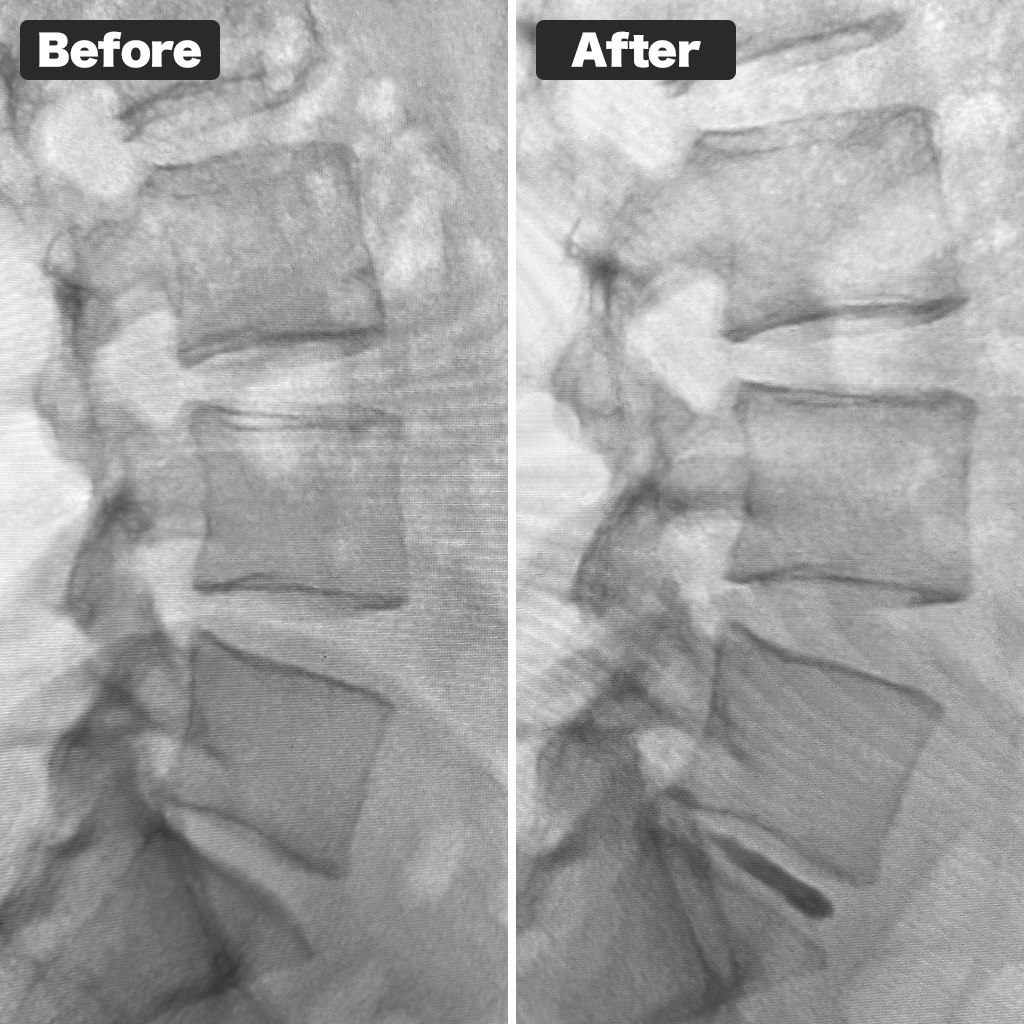 Foto X-ray sebelum dan sesudah perawatan