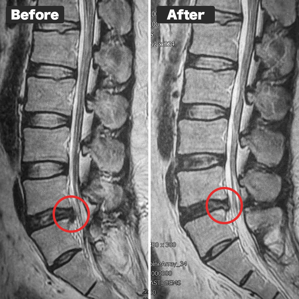 Foto MRI sebelum dan sesudah perawatan