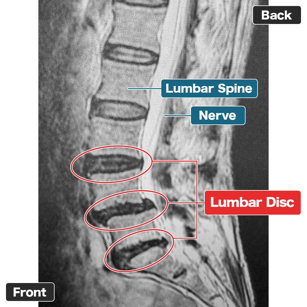 MRI