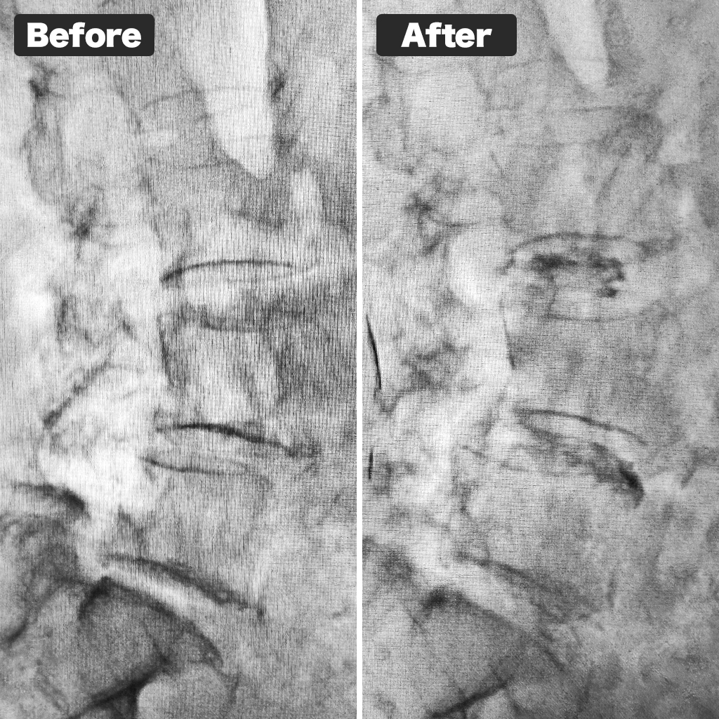 Foto X-ray sebelum dan sesudah perawatan