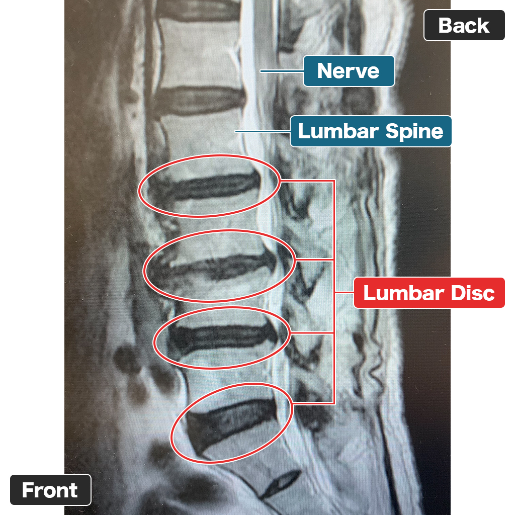 MRI