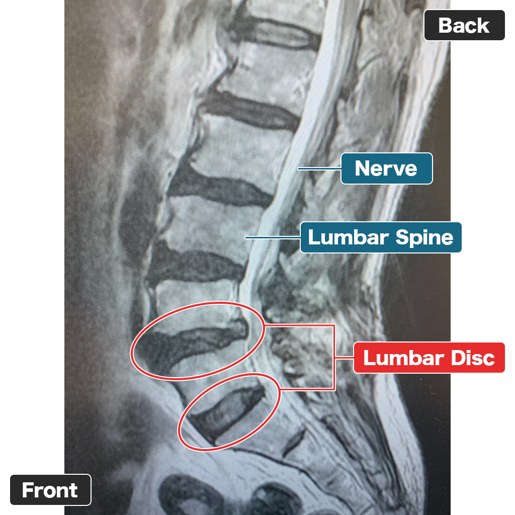 MRI