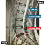 Pria Berusia 40-an yang Menjalani PLDD (Dekompresi Laser Perkutan Diskus) untuk Hernia Diskus