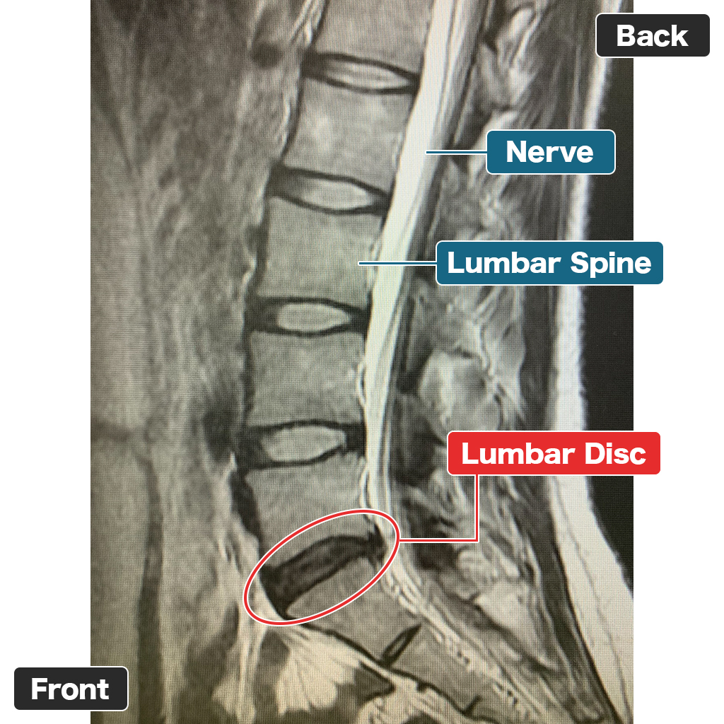 MRI