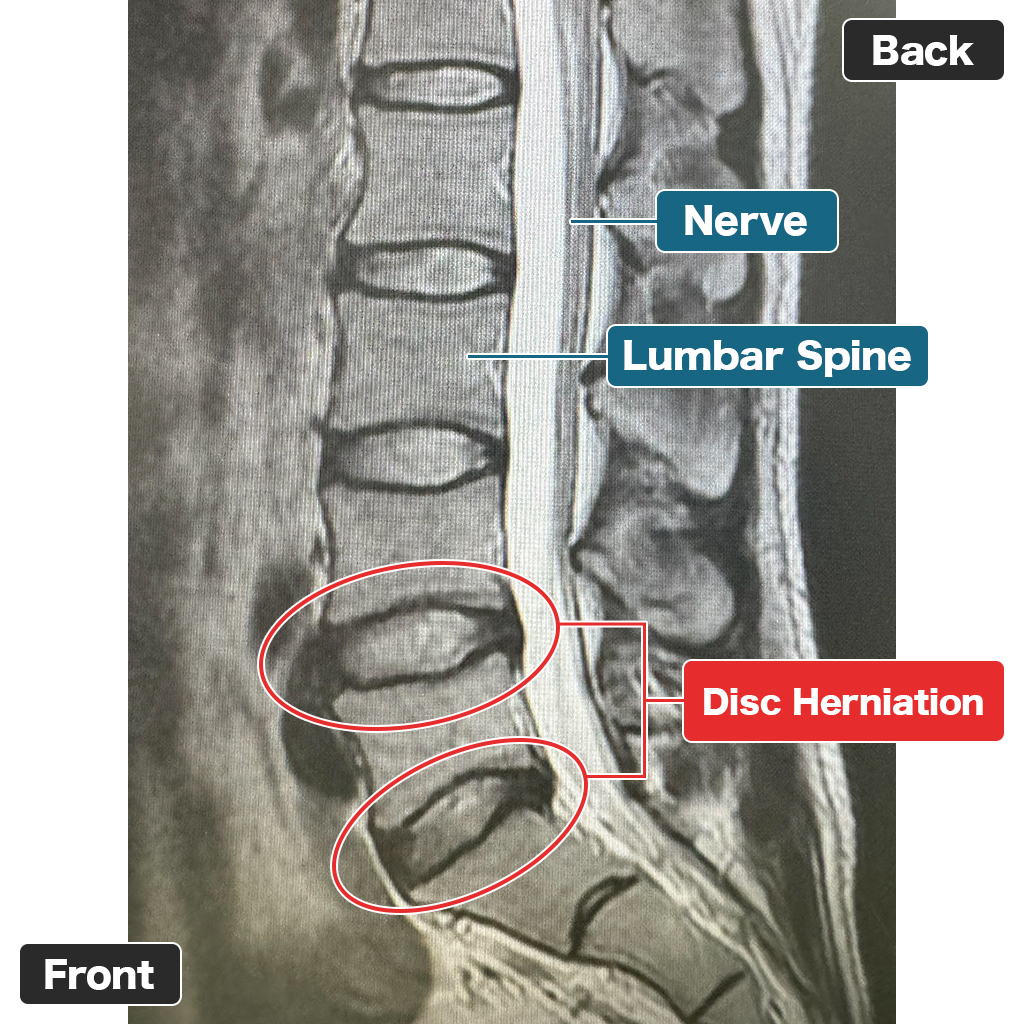 MRI