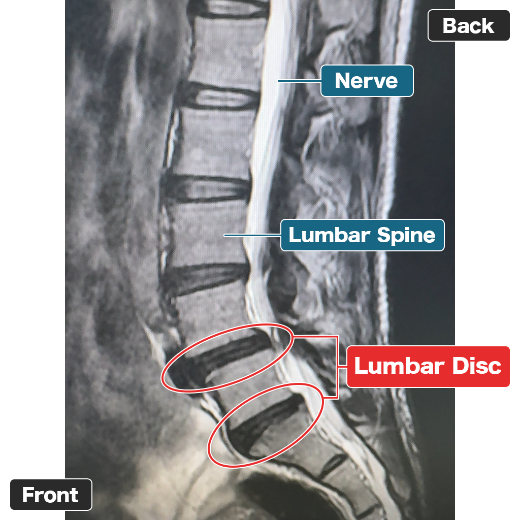 MRI