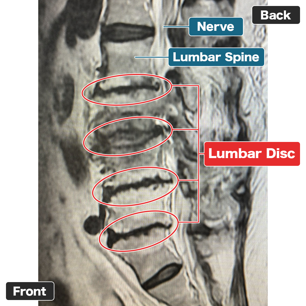 MRI