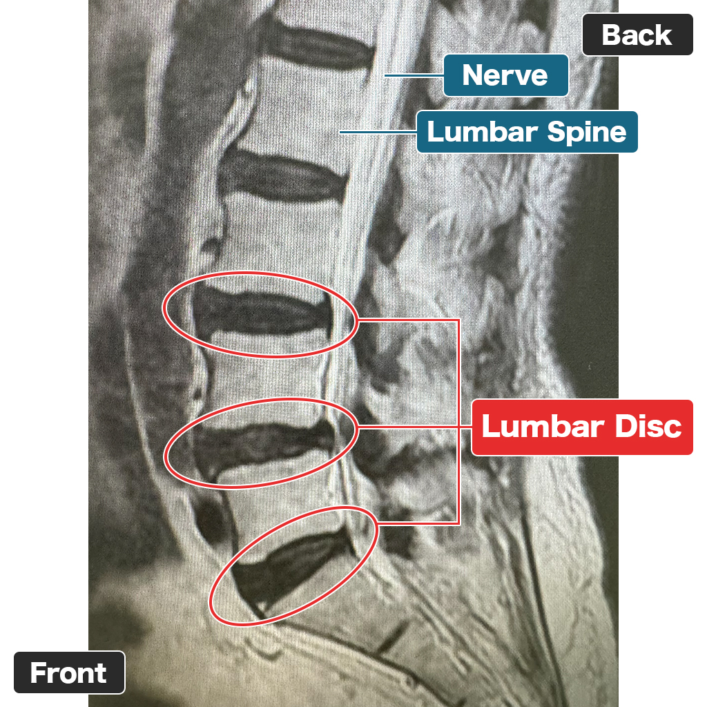 MRI