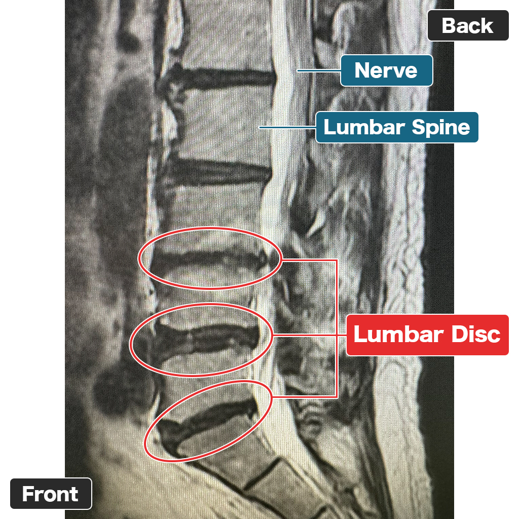 MRI