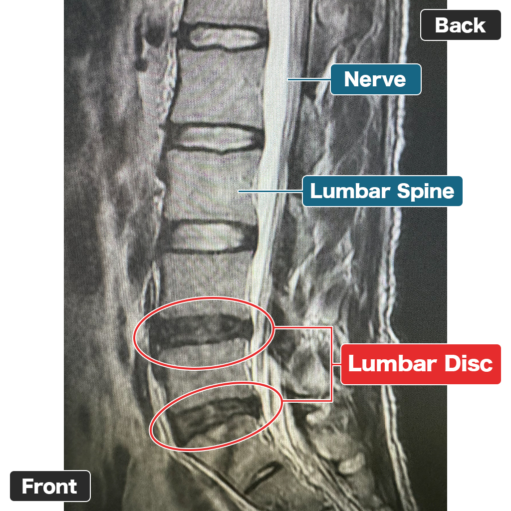 MRI