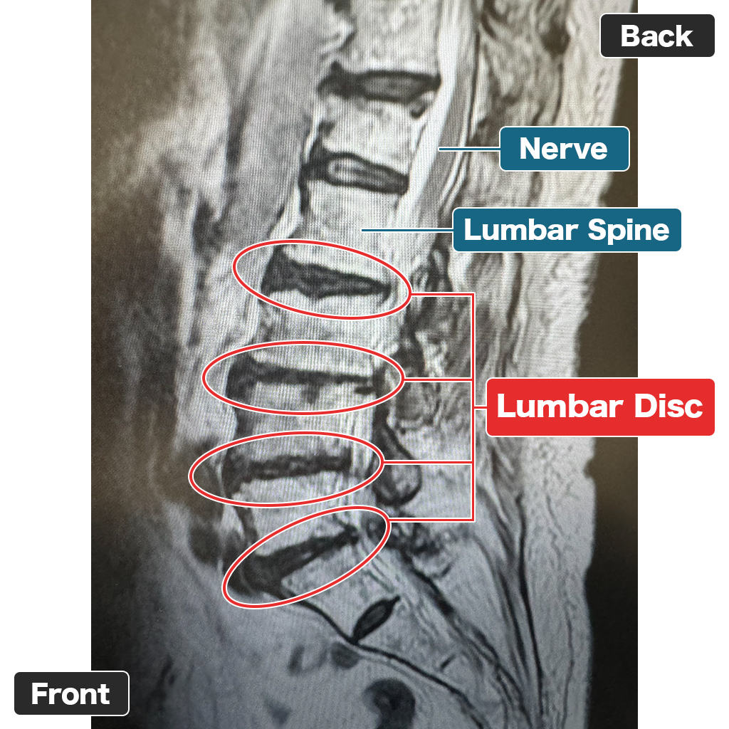 MRI