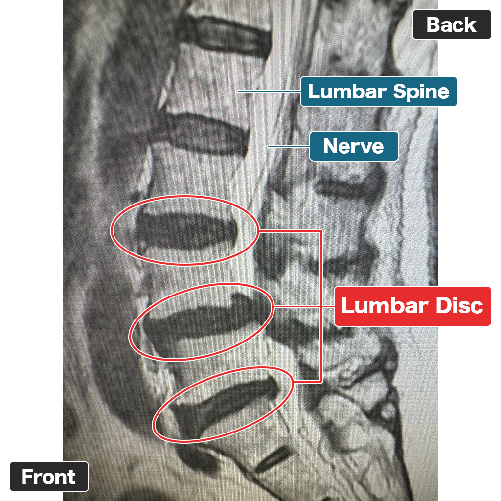 MRI