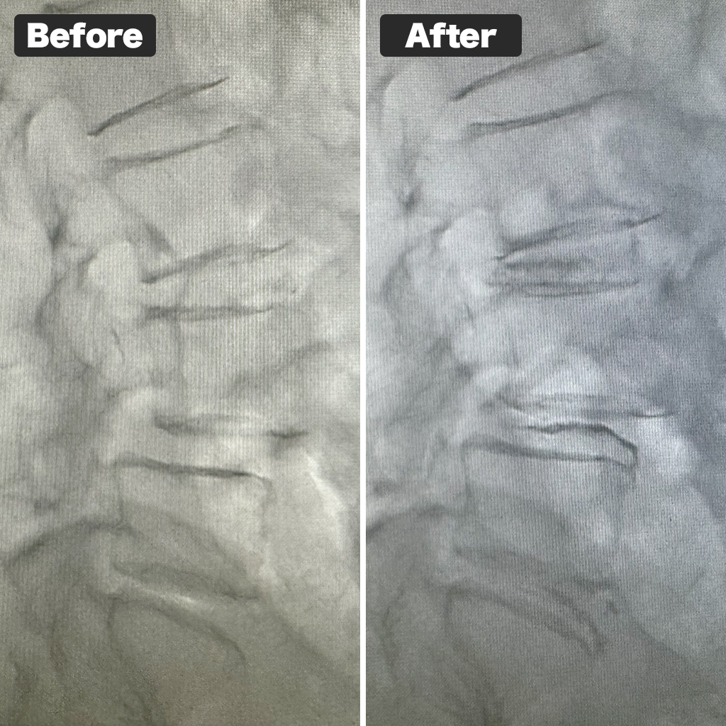 X-ray before and after treatment