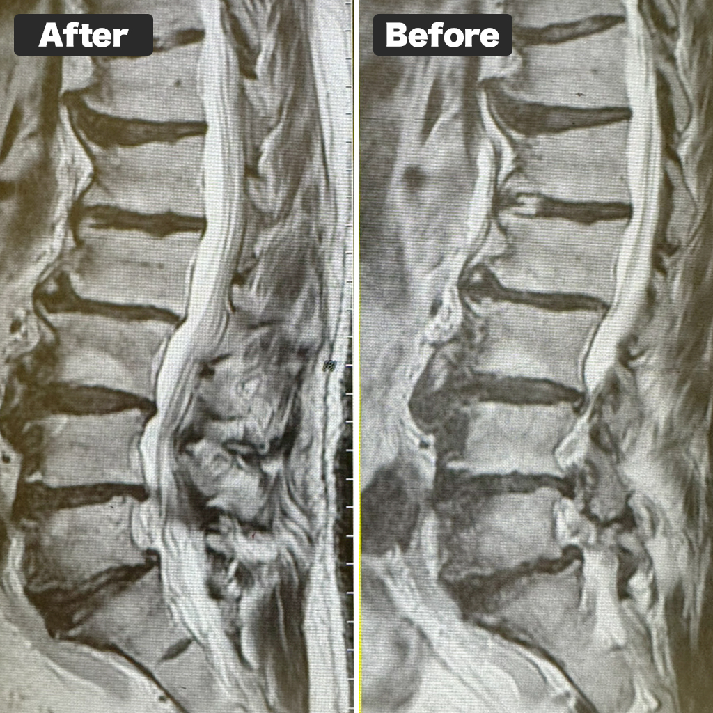 MRI Before and After Treatment