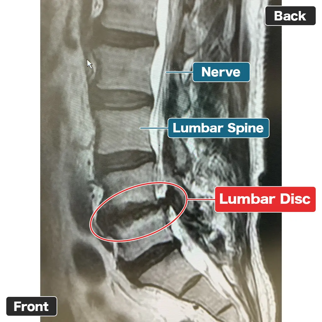 MRI