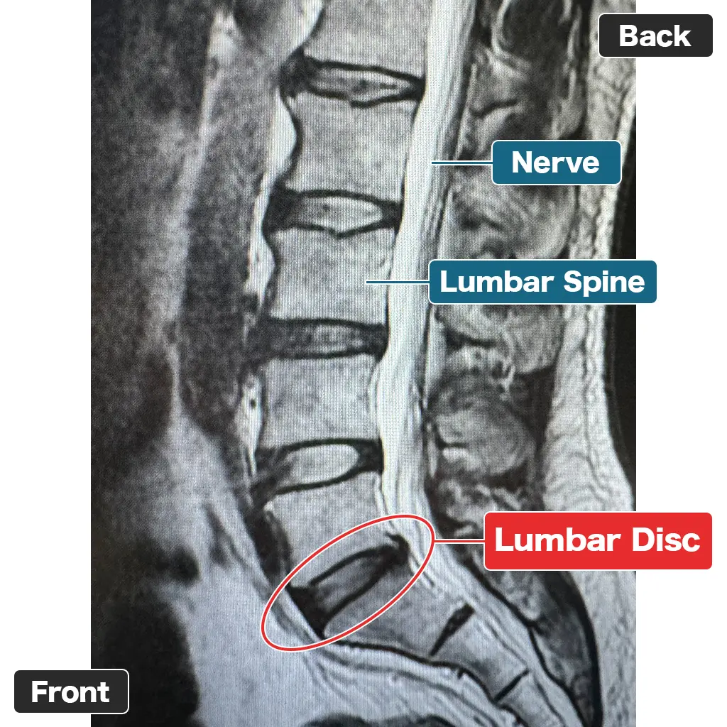 MRI