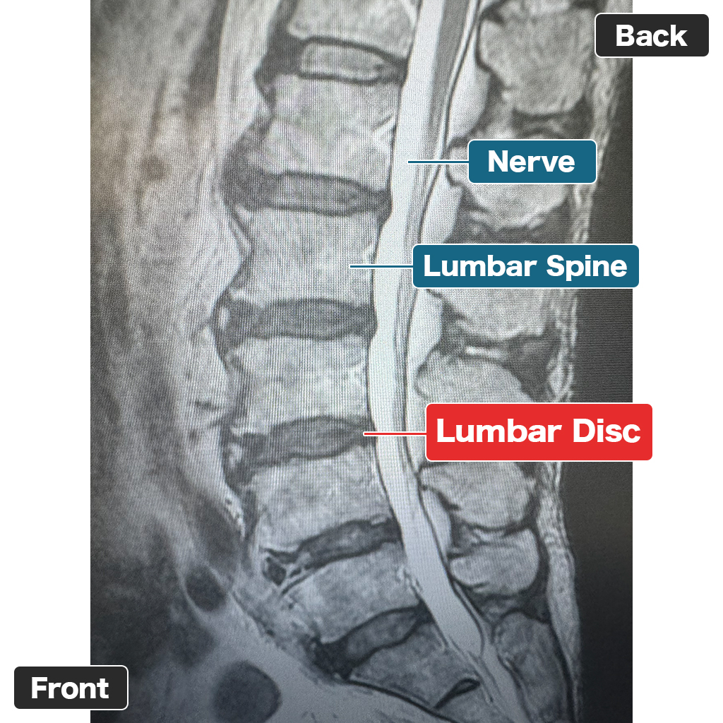 MRI