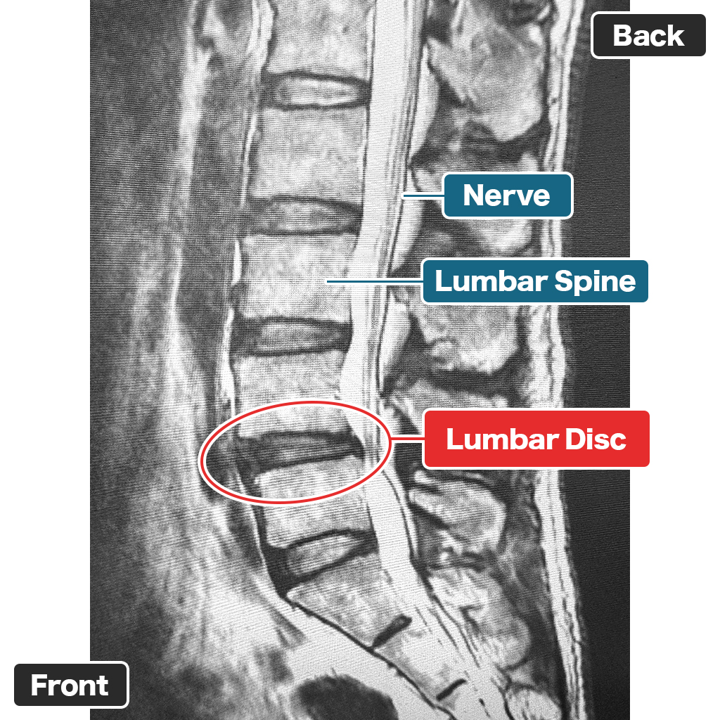 MRI