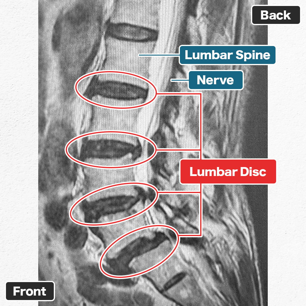 MRI